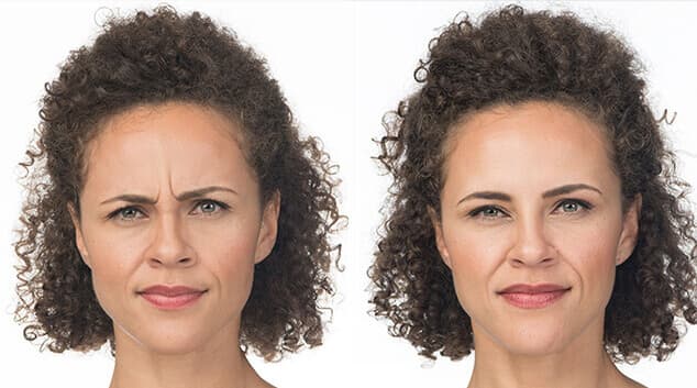 botox benefits for face