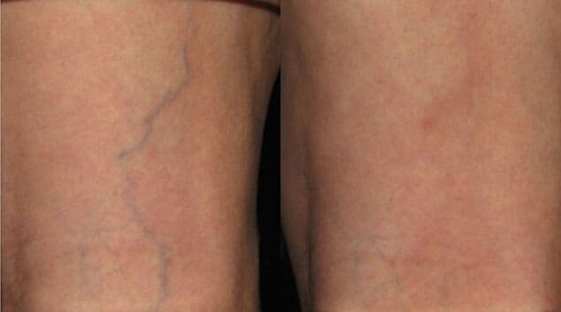 Spider vein removal results