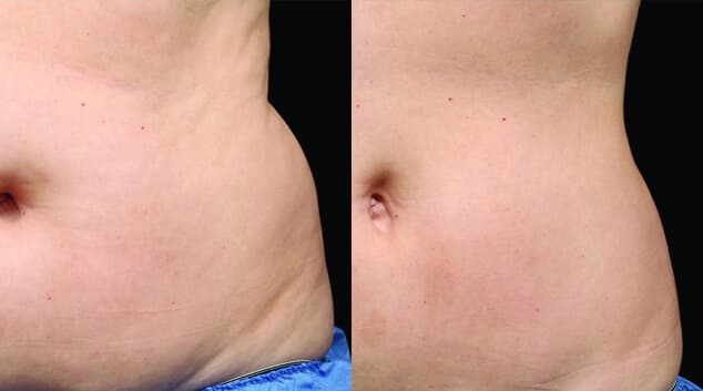 CoolSculpting Before After