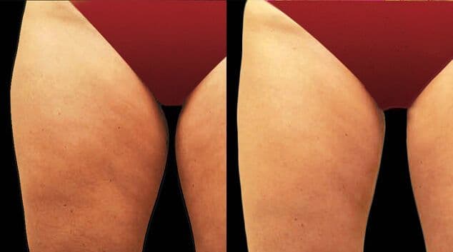 results of coolsculpting