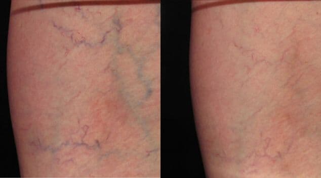 Spider vein before after