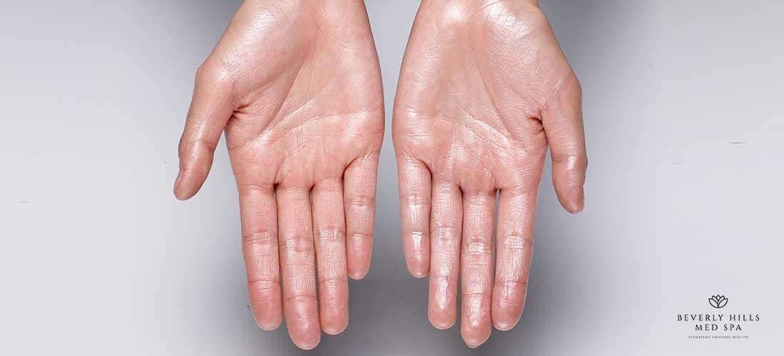 How To Get Rid Of Sweaty Hands 