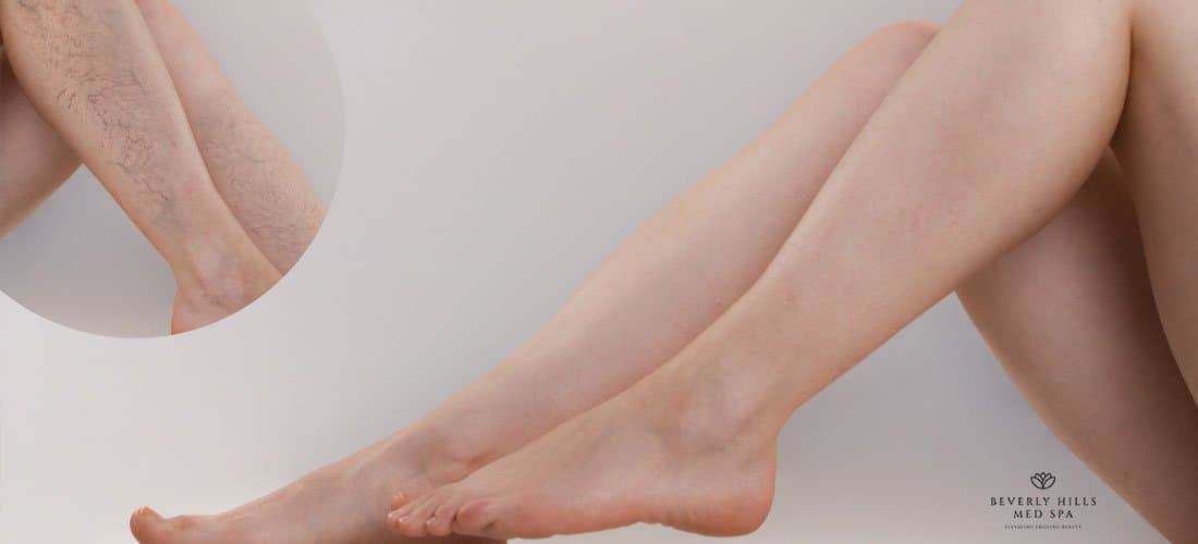 How To Get Rid Of Spider Veins And Its Causes