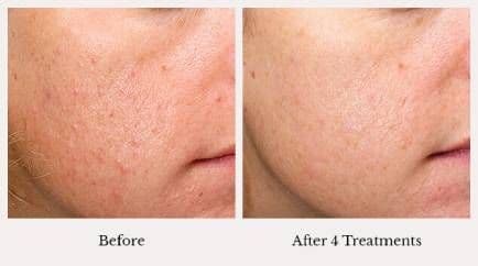 Microneedling facial acne