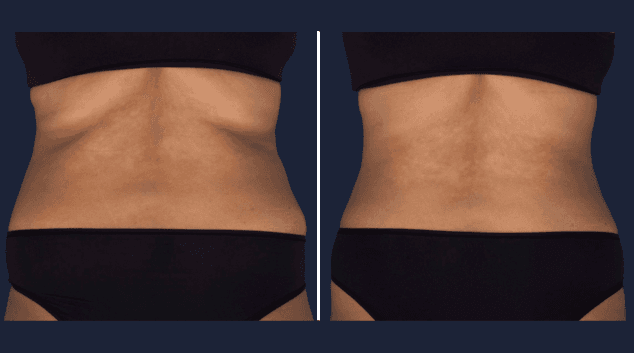 CoolSculpting Elite love handles results