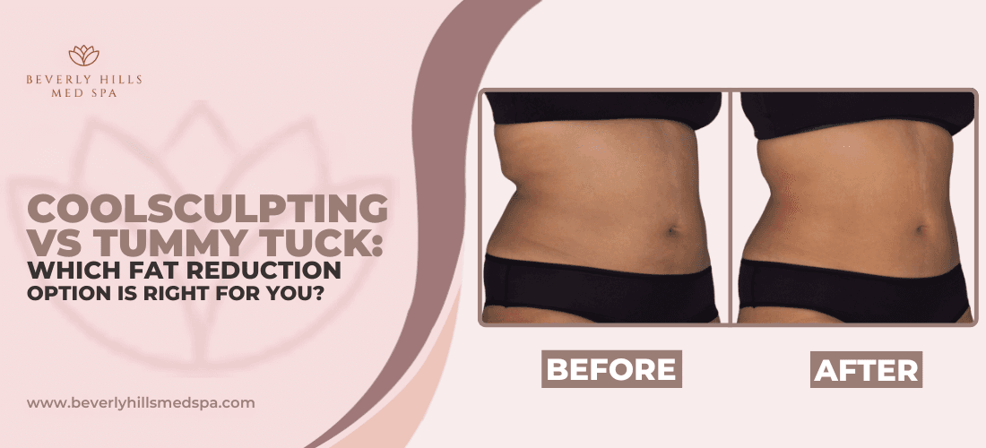 coolsculpting-elite-vs-tummy-tuck