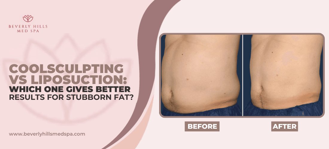 coolsculpting-vs-liposuction