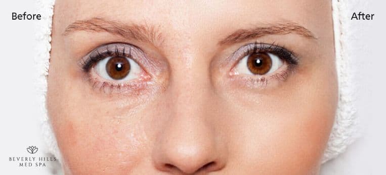 Does Microneedling Work To Stimulate Skin and Make You Look Younger? 