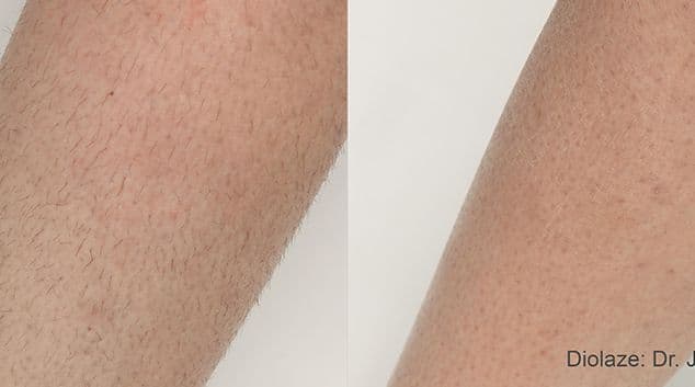 Laser hair removal results