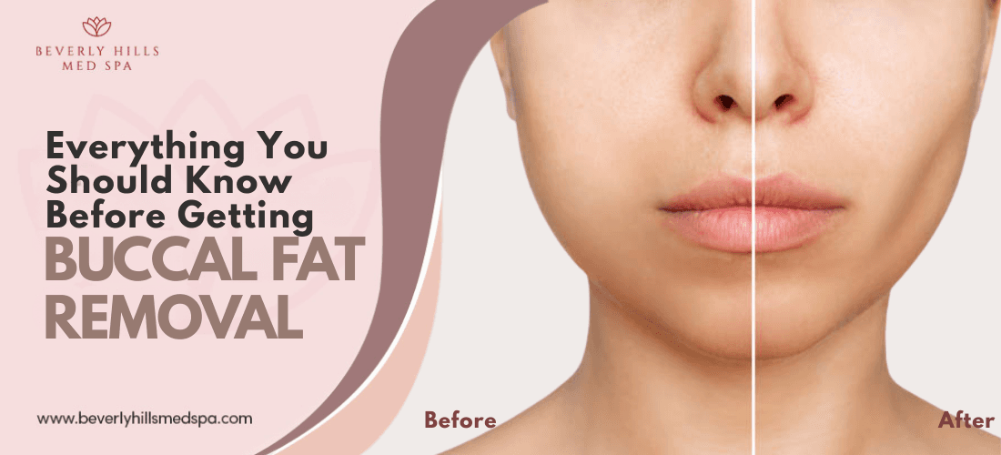 Everything You Should Know Before Getting Buccal Fat Removal
