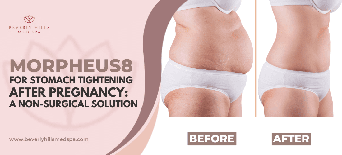 Morpheus8 for Stomach Tightening After Pregnancy: A Non-Surgical Solution