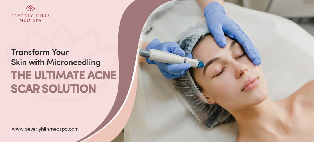 Transform Your Skin with Microneedling: The Ultimate Acne Scar Solution