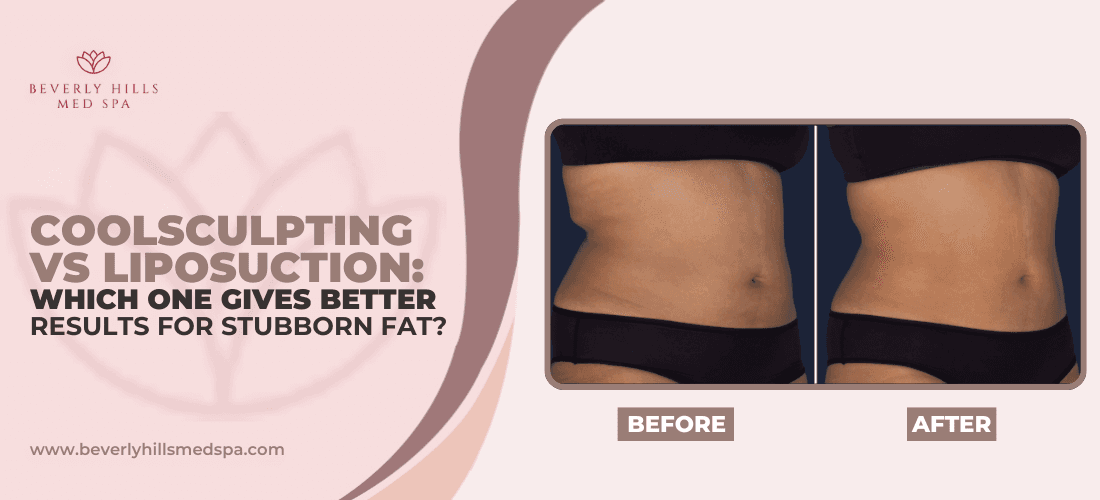 coolsculpting-vs-liposuction