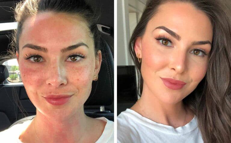 is microneedling worth it