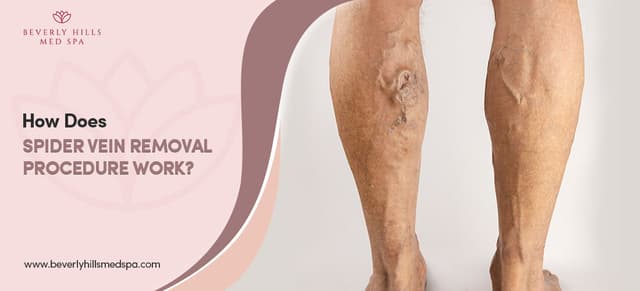 Spider Med Spider Vein Removal Procedure