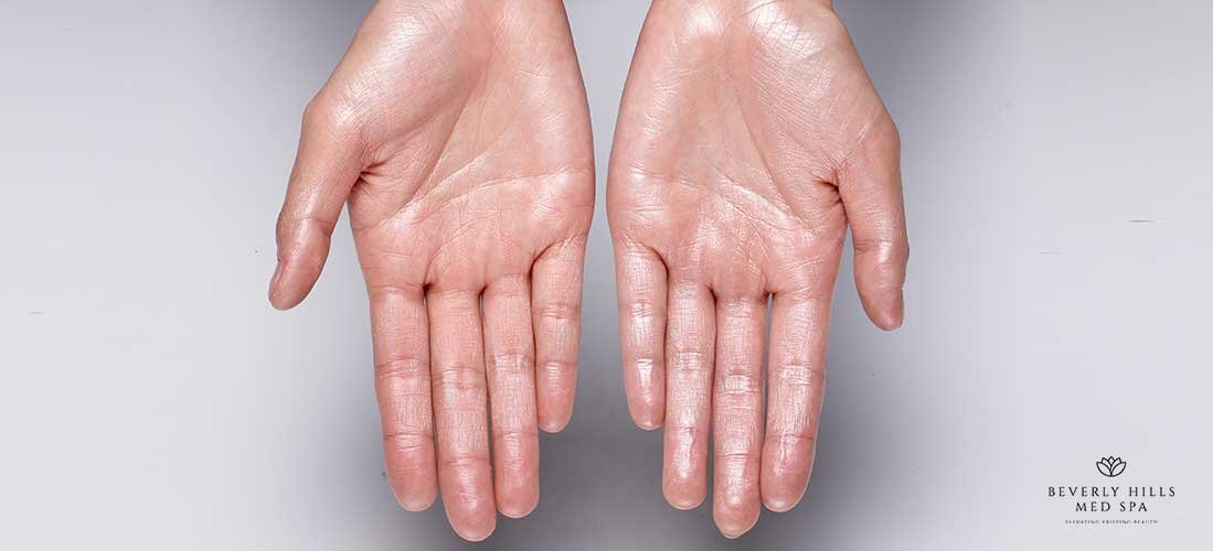 how-to-get-rid-of-sweaty-hands-Beverly-Hills-Med-Spa