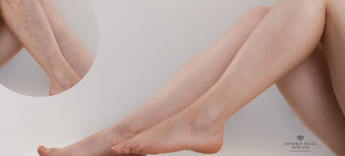 how-to-get-rid-of-spider-veins-Beverly-Hills-Med-Spa