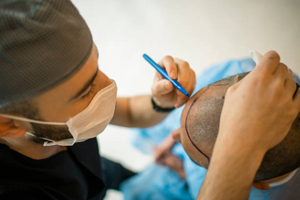 fue-hair-transplant