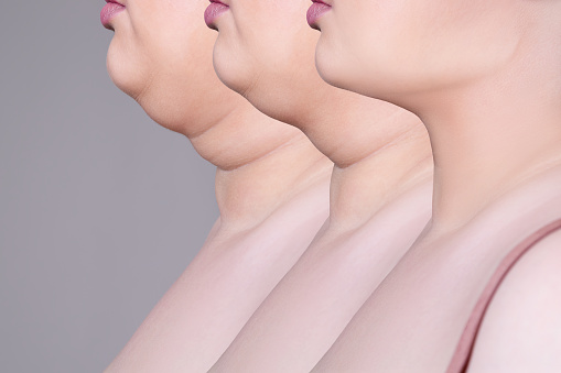 kybella-vs-coolsculpting