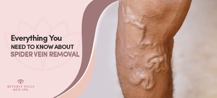 Spider Vein Removal