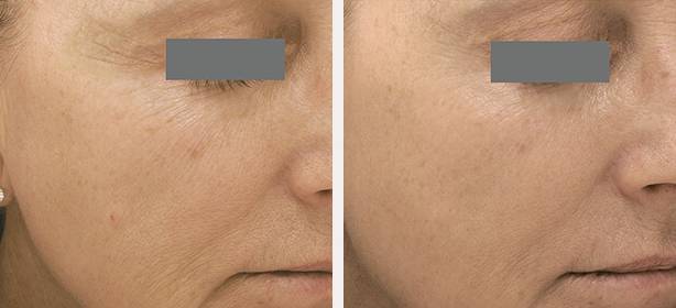 BA-Exceed-MTderm-wrinkle-4Tx_004