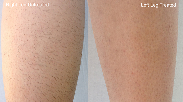 laser-hair-removal2