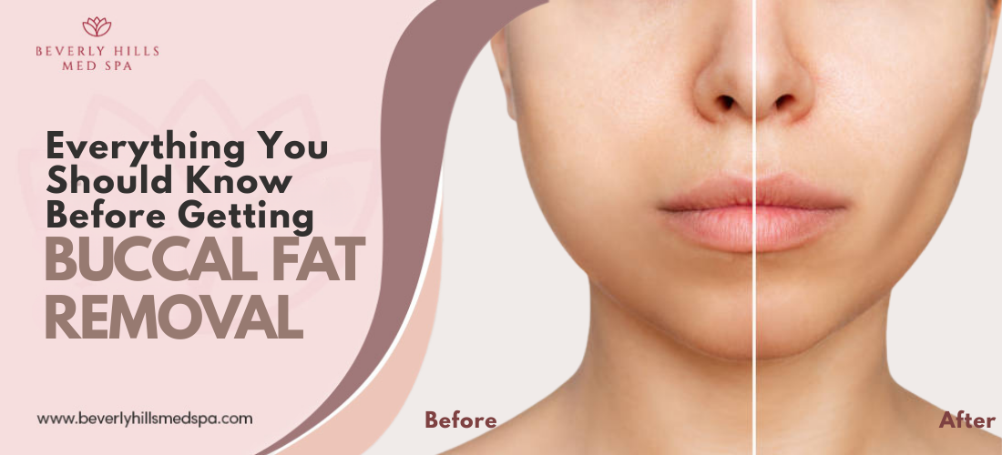 buccal fat removal