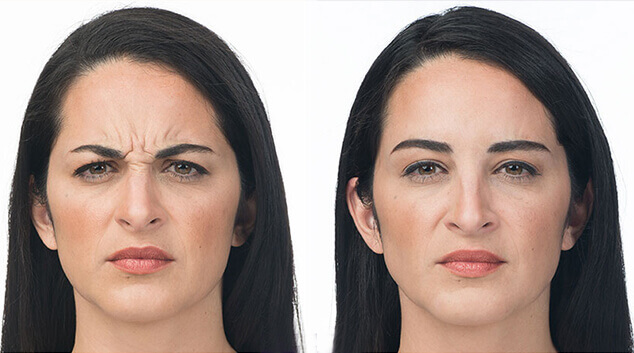 botox results