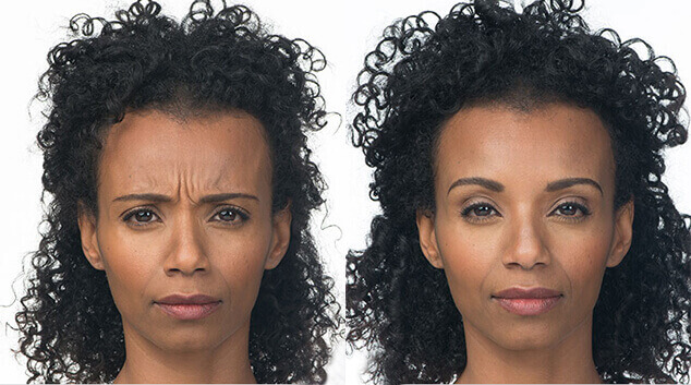 botox before and after