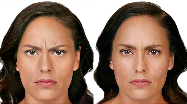 results from botox