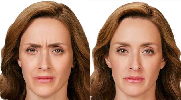 botox injection results