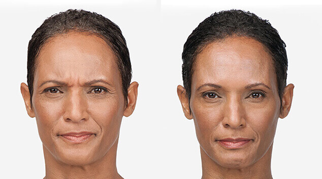 full botox results