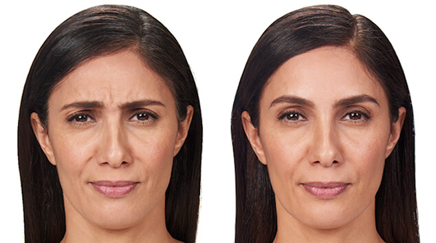 botox before and after results