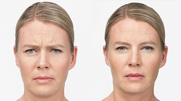 botox results before and after