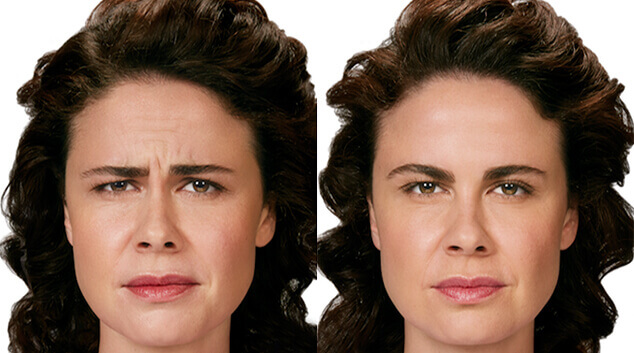botox results forehead
