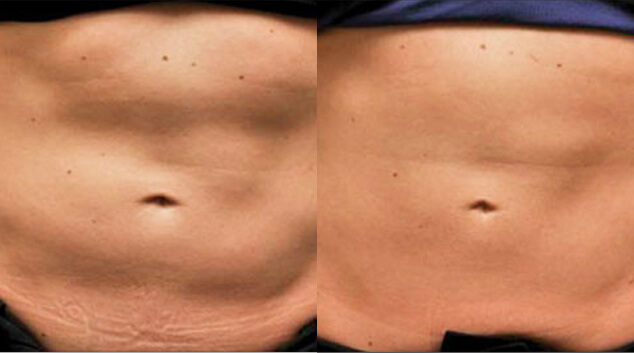 coolsculpting results stomach