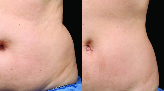 coolsculpting results before and after