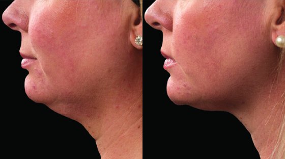 coolsculpting before and after