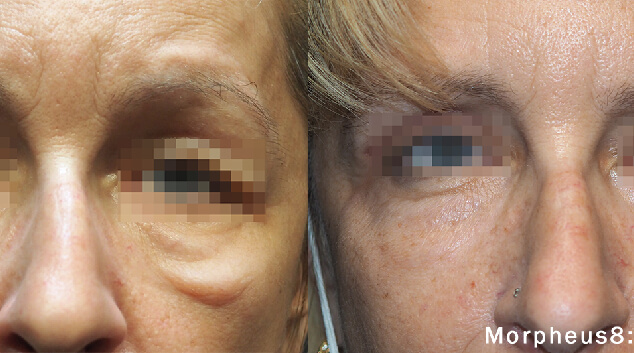 morpheus8 treatment results before after