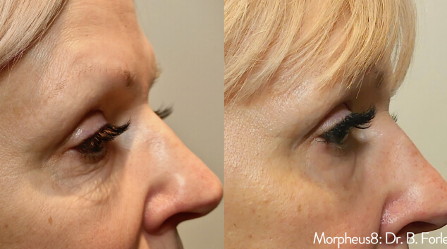 results from morpheus8