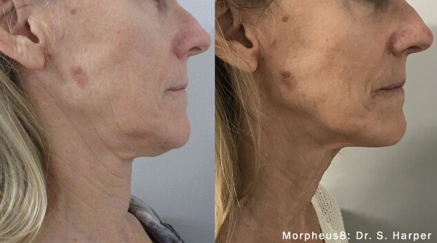 morpheus 8 before and after