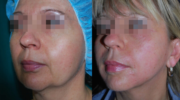 morpheus 8 before & after