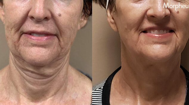 morpheus 8 before after