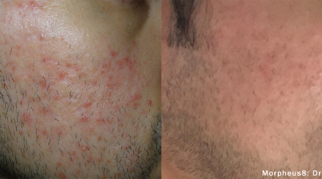 morpheus8 results pictures