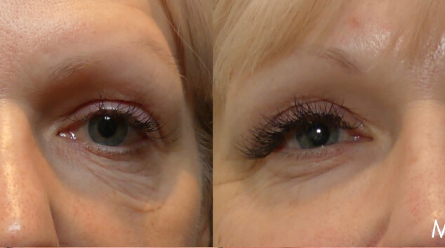 morpheus8 under eye results