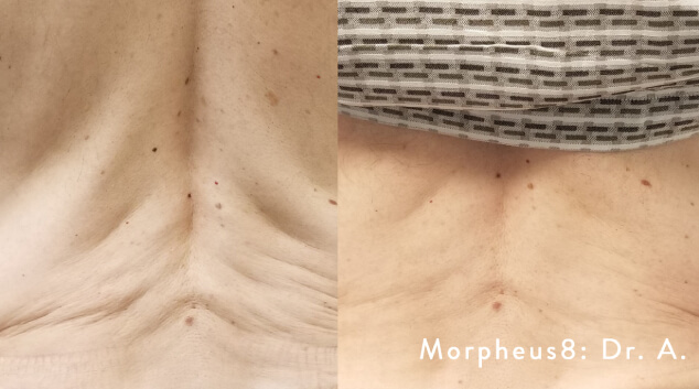 results after morpheus8