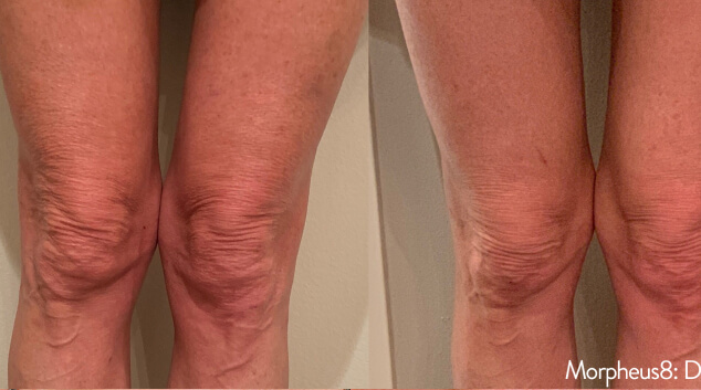 morpheus8 treatment results timeline