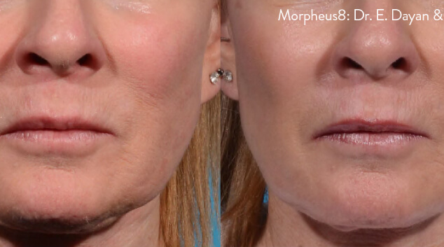 morpheus8 before after face results