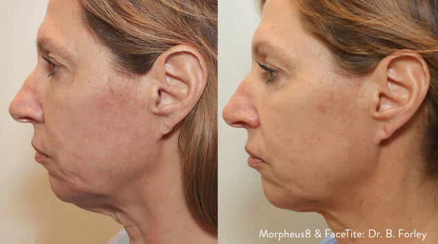 morpheus8 results before after