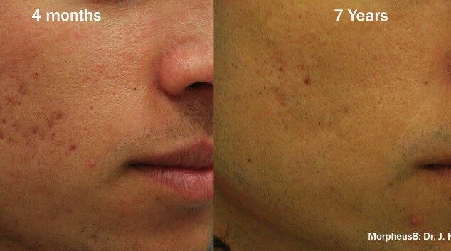 morpheus8 results last